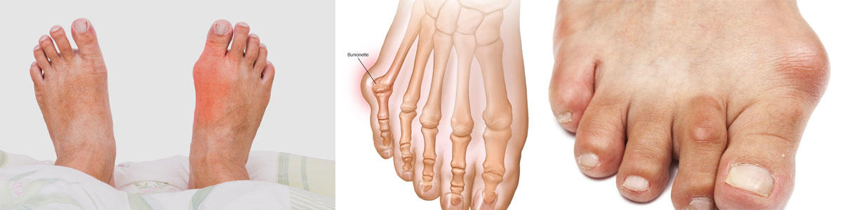 BUNION