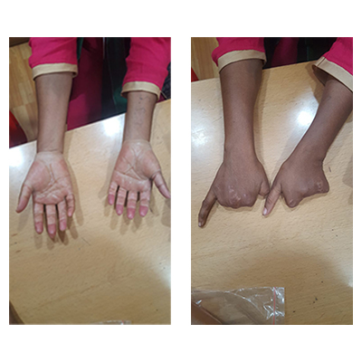 Spinal-Orthotics