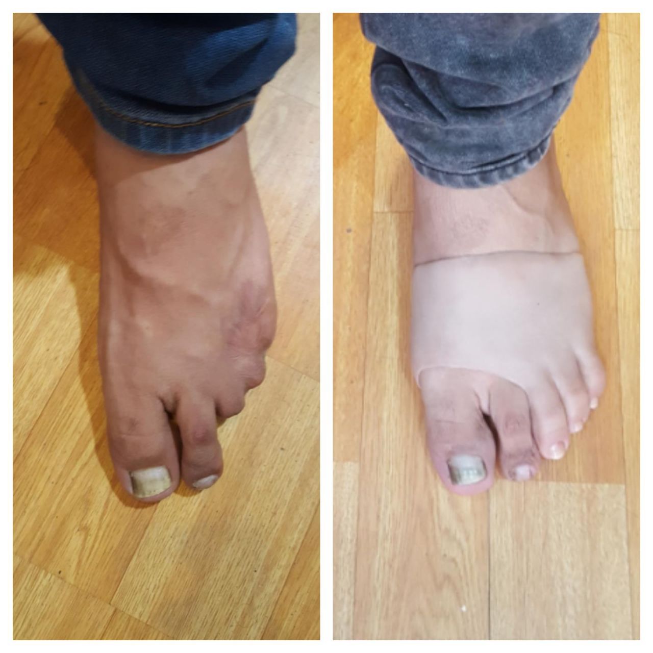 Partial foot prosthetic socket India — Pro-Ortho Perfect India