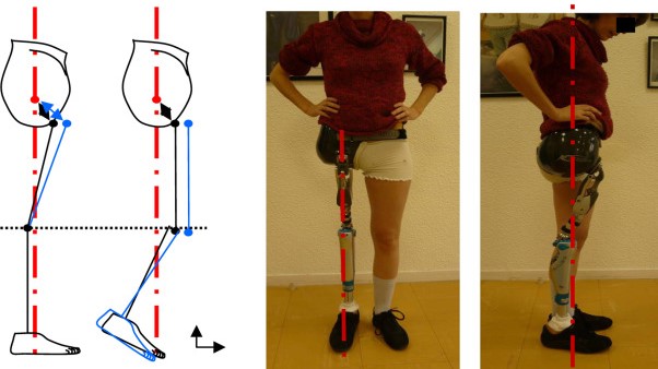 Knee disarticulation through knee prosthetic India — Pro-Ortho Perfect India